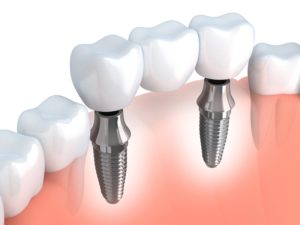 Affordable dental Implants
